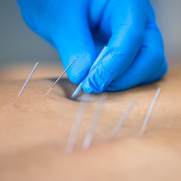 LES BIENFAITS DE L’ACUPUNCTURE – INTERVIEW DU DR ROBERT CORVISIER